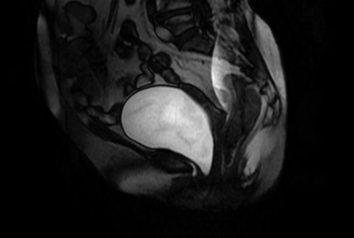 Сагиттальное изображение МРТ при пробе Вальсальвы