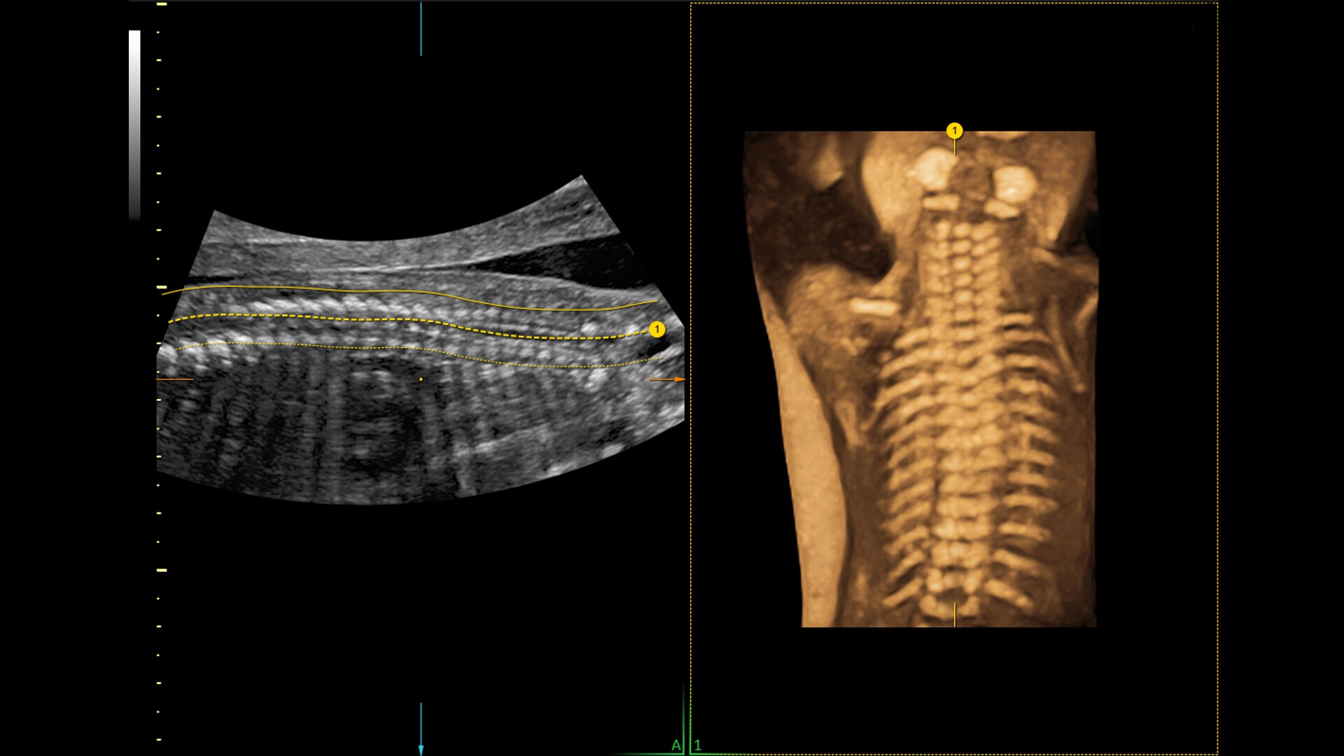 Spine Trace