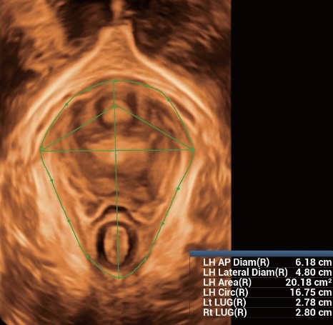 Smart Pelvic