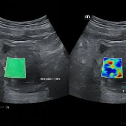 Базовые и расширенные ультразвуковые методы оценки эмболизации артерии предстательной железы