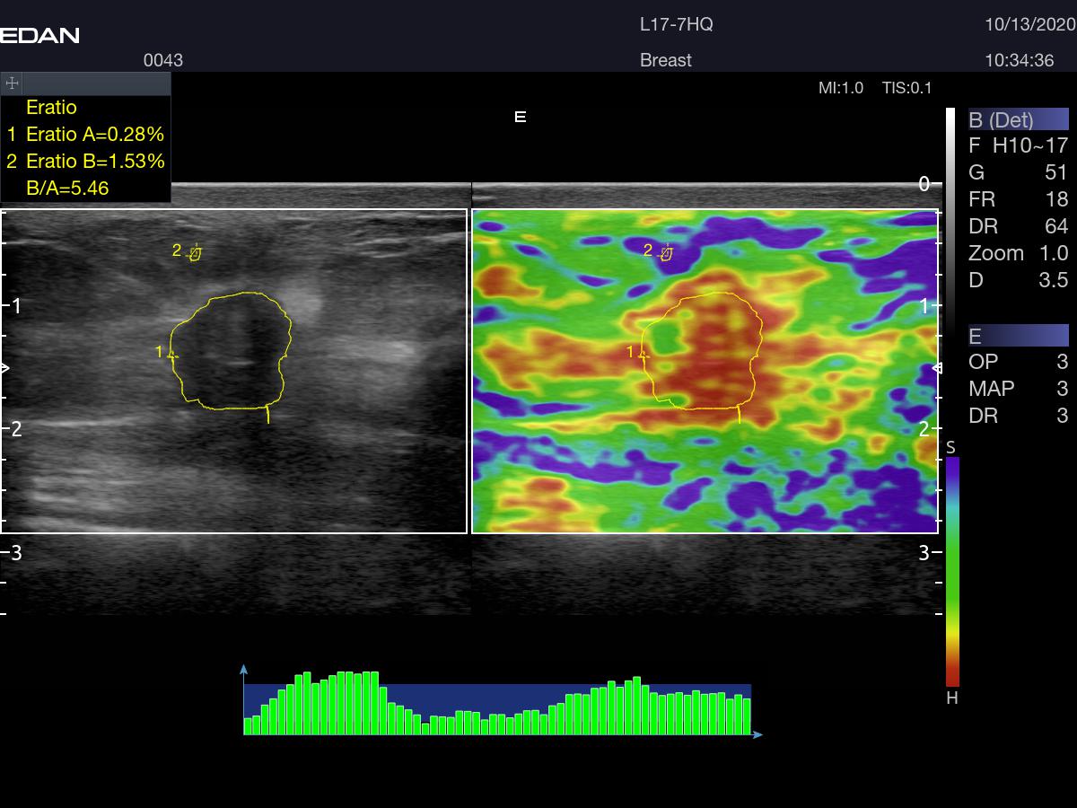 Elastography