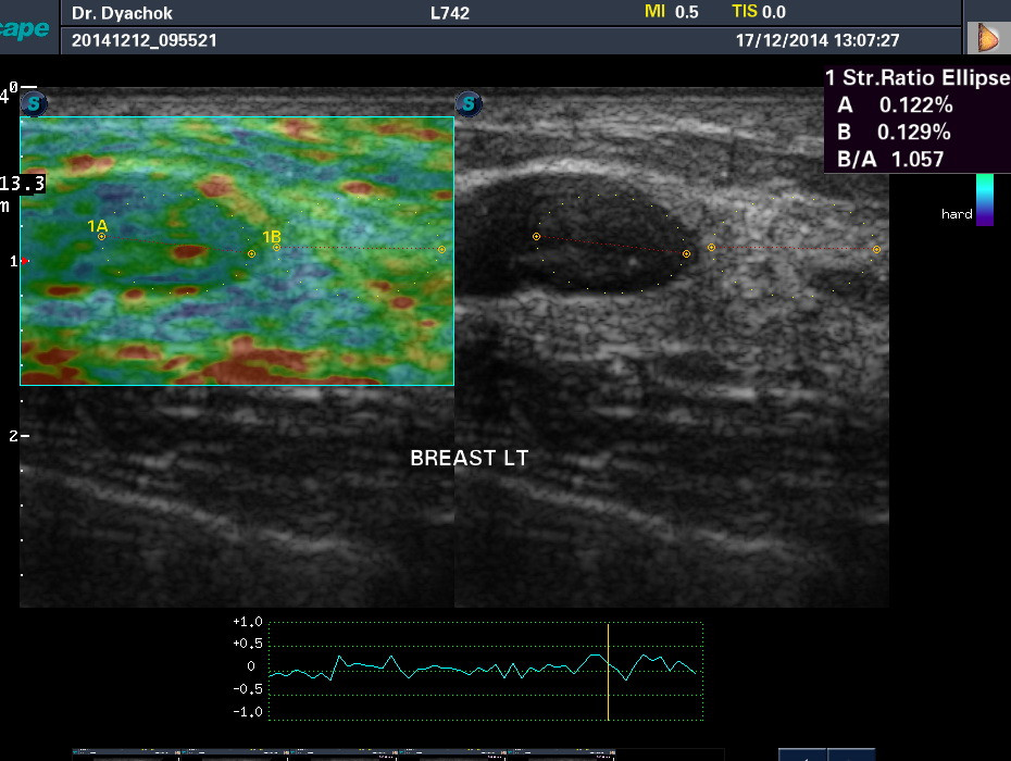 Elastography