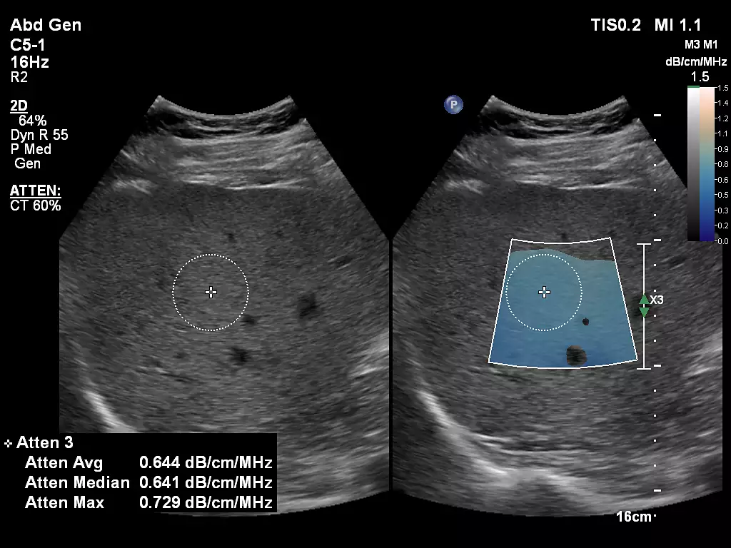 Liver Fat Quantification