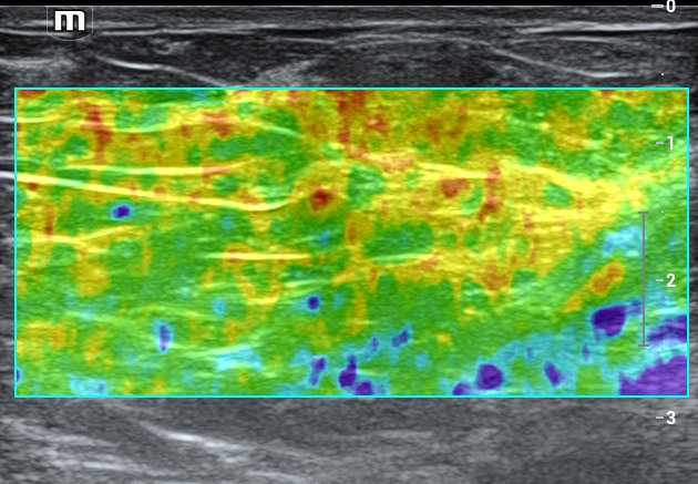 Strain Elastography