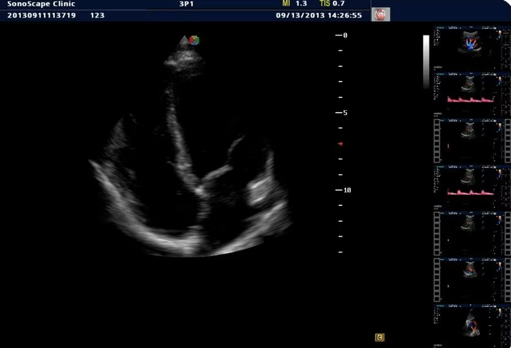 Stress Echo