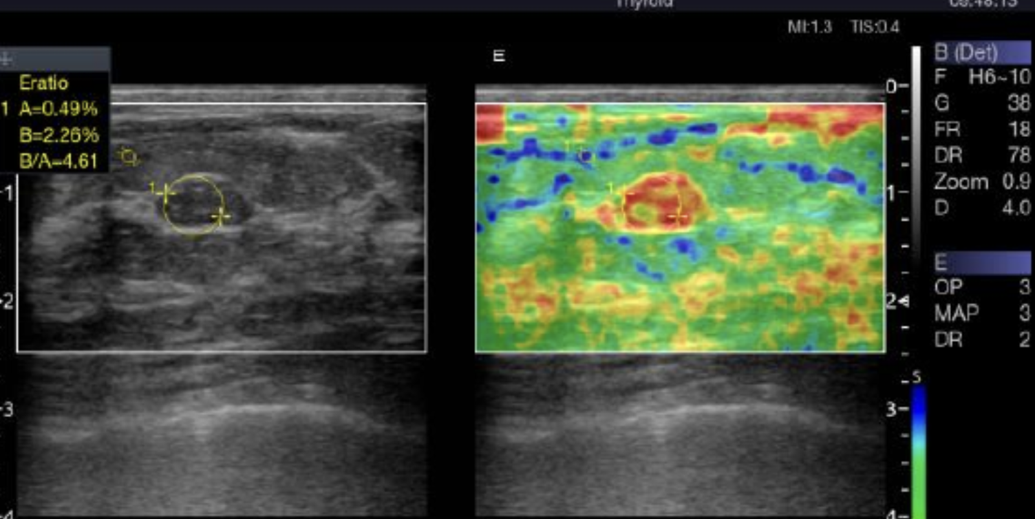 Elastography