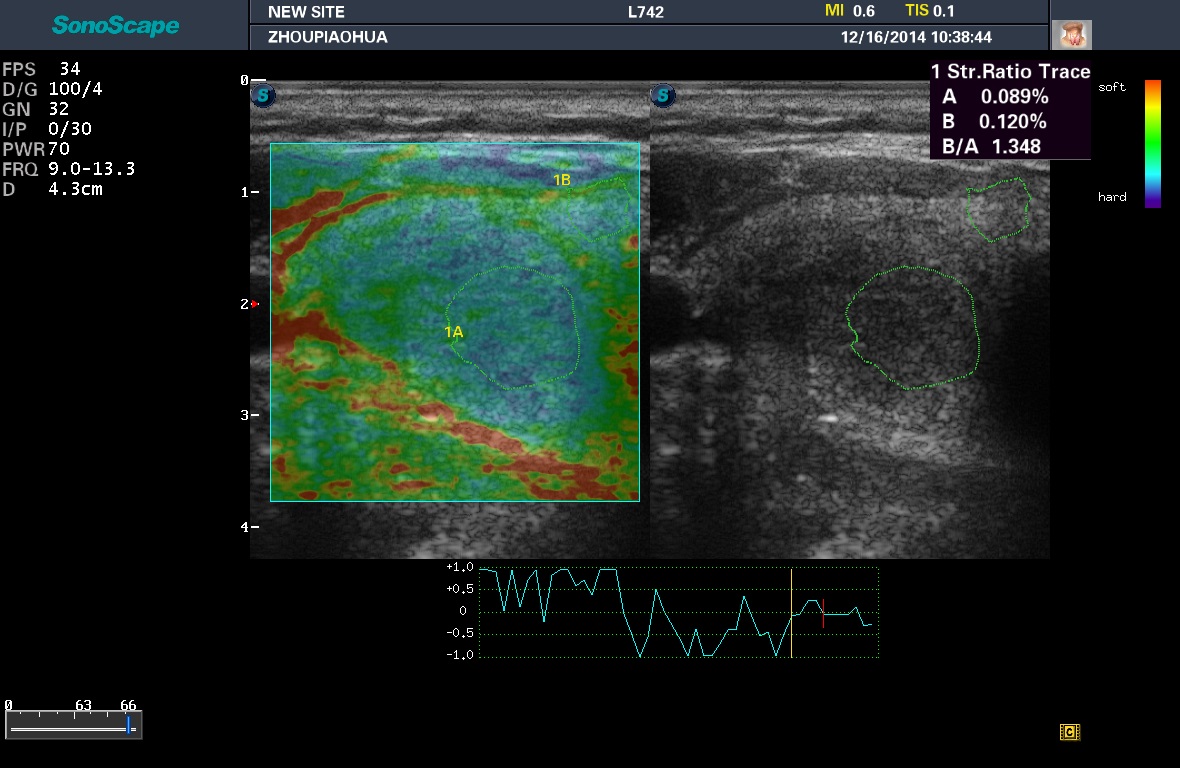 Elastography 