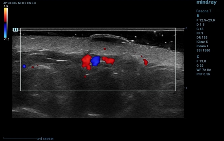 Ультразвуковое изображение с использованием режима ЦДК на аппарате Resona 7, демонстрирующее кровоток в мягких тканях.
