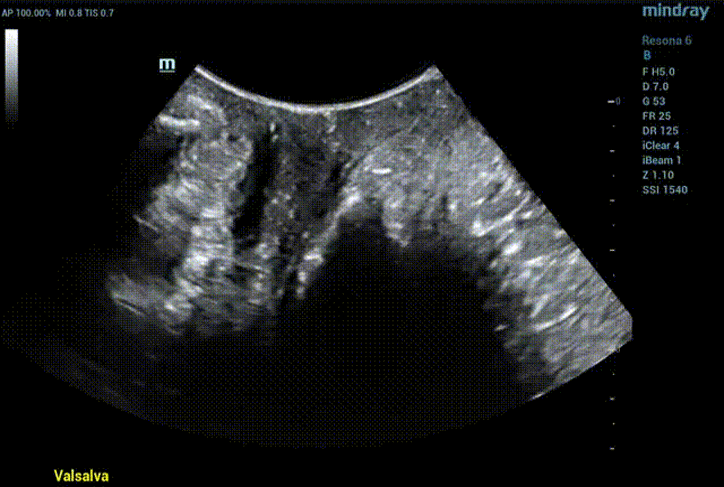 Двухмерный ультразвуковое сканирование демонстрирует движение тазового дна во время проведения пробы Вальсальвы
