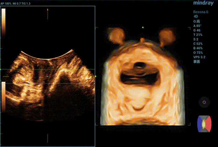 Картина трехмерного УЗ-сканирования области ануса при пробе Вальсальвы