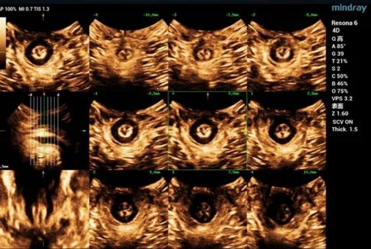 Ультразвуковая томография показывает интактность внутреннего и внешнего сфинктеров ануса