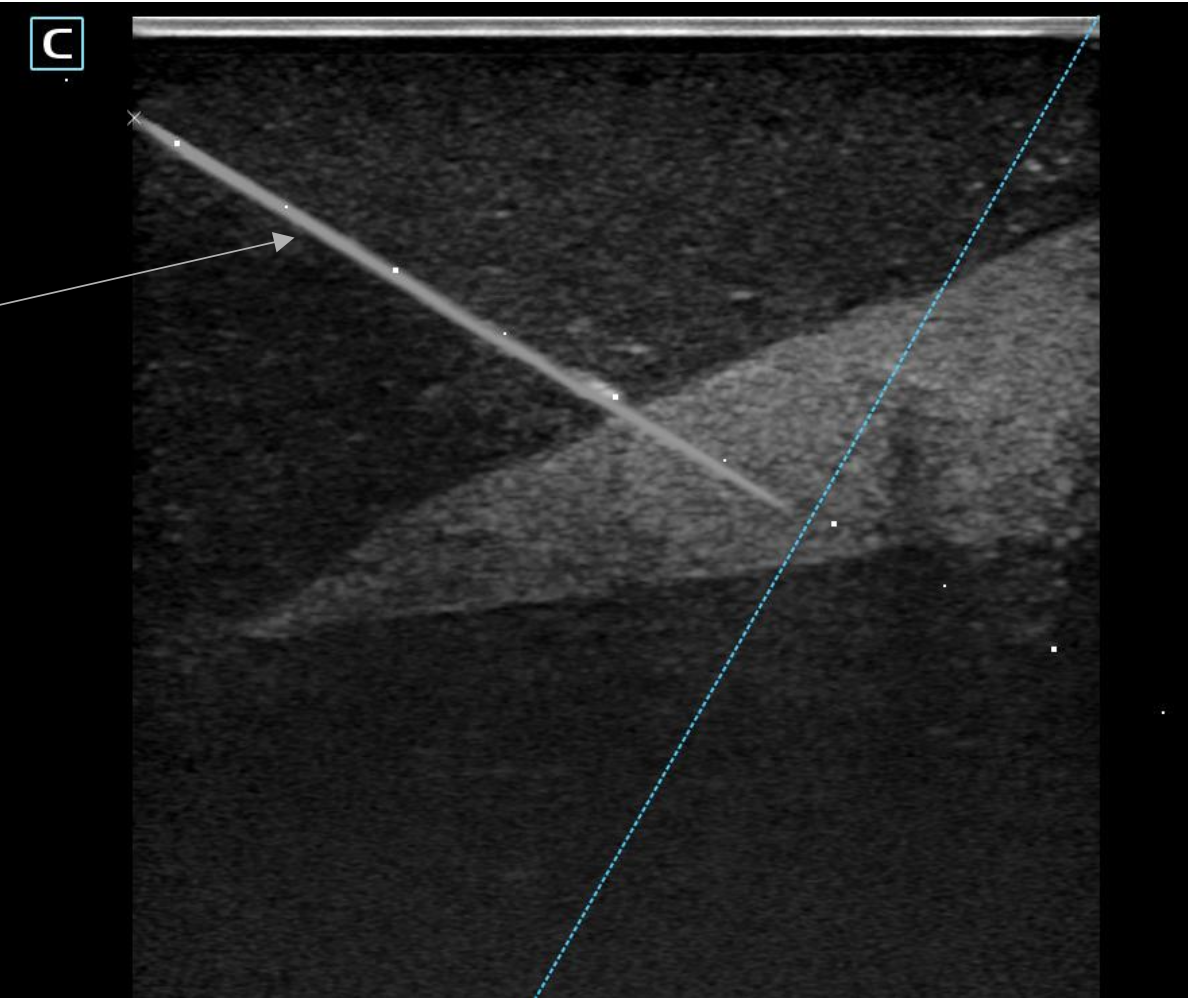 Yi-Needle