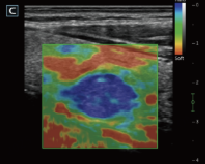 Elastography